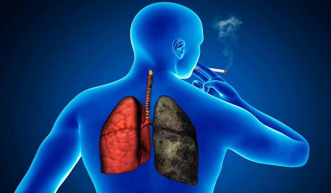 Курение как ведущий фактор риска рака легких