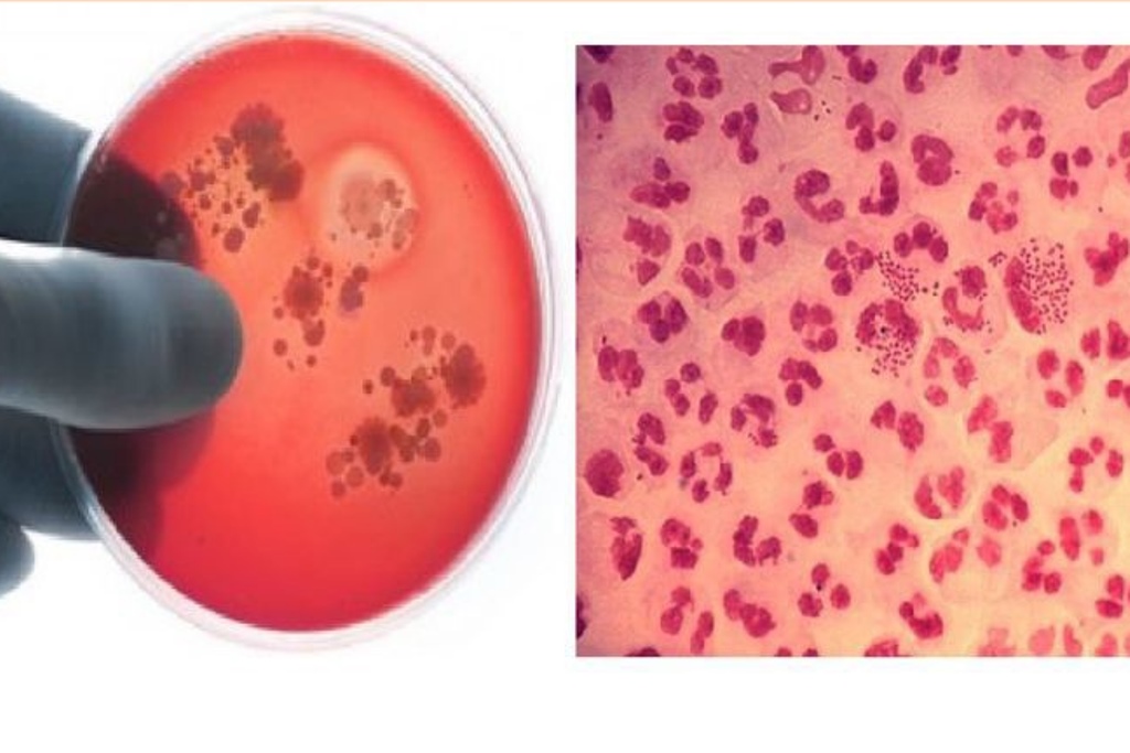 Что нужно знать, чтобы не заболеть менингококковой инфекцией Что нужно знать, чтобы не заболеть менингококковой инфекцией