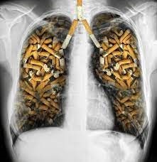Курение и рак легких: связь, воздействие и последствия