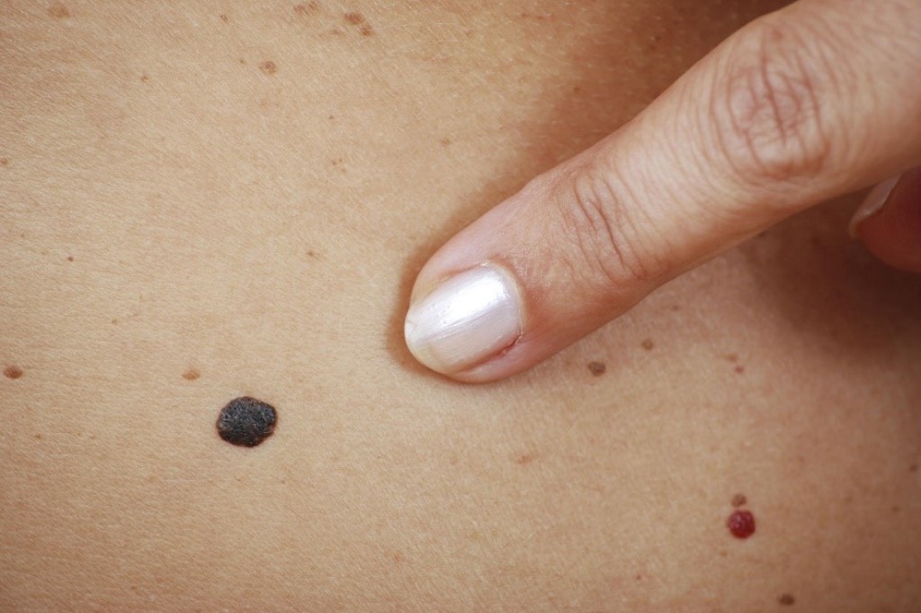 Меланома: опасная форма рака кожи, которую следует знать и защищаться