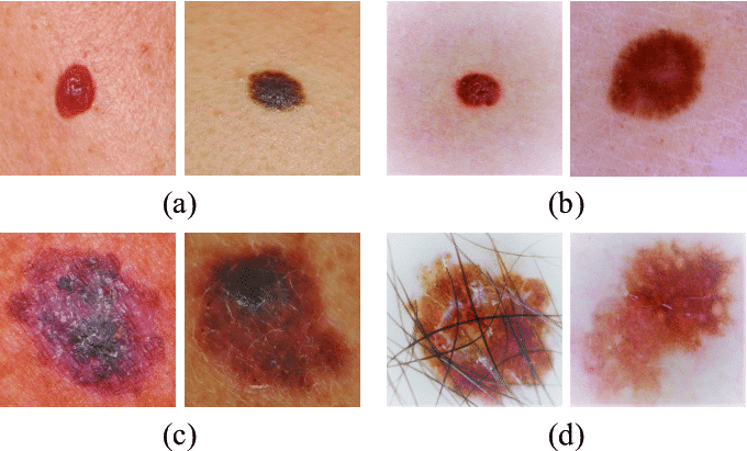 A, B, C, D, E - 5 признаков ранней диагностики рака кожи (меланомы)