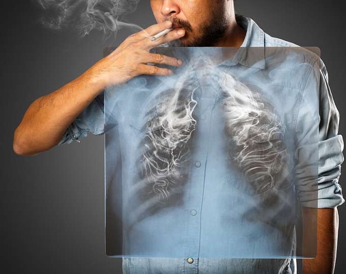 Курение и рак: причины рака легких